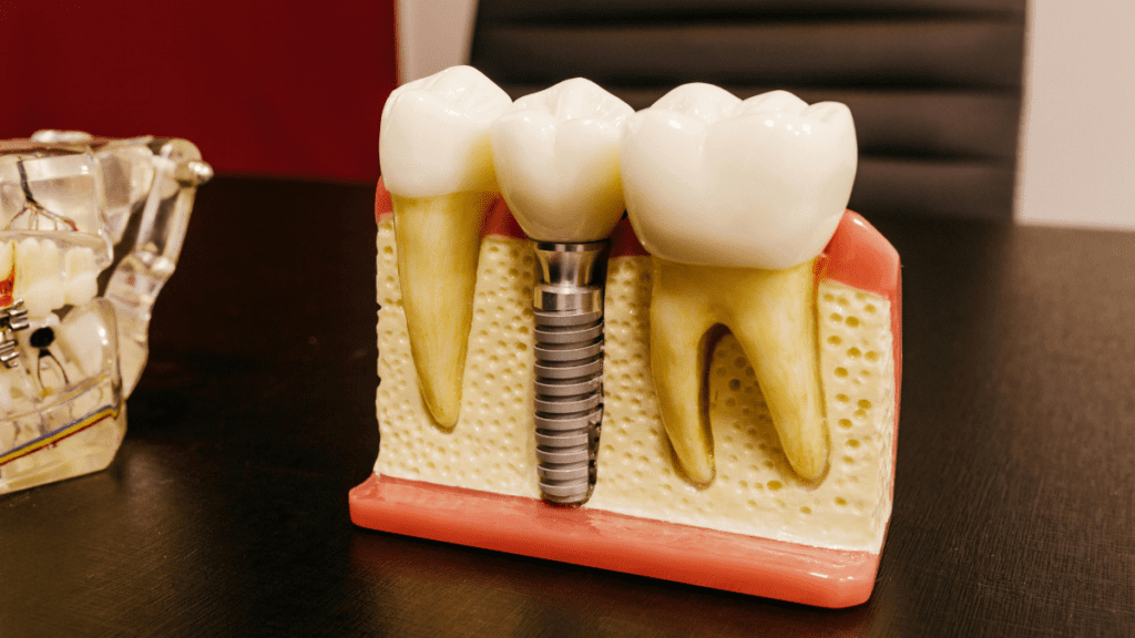 why no dairy after dental implant