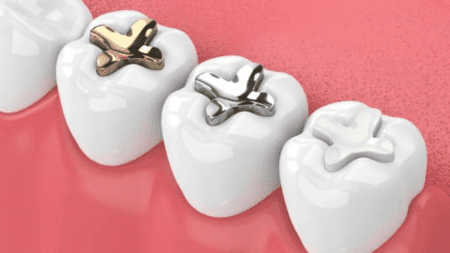 Dental amalgam