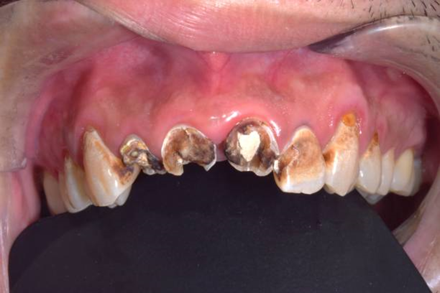 Cavity on front tooth