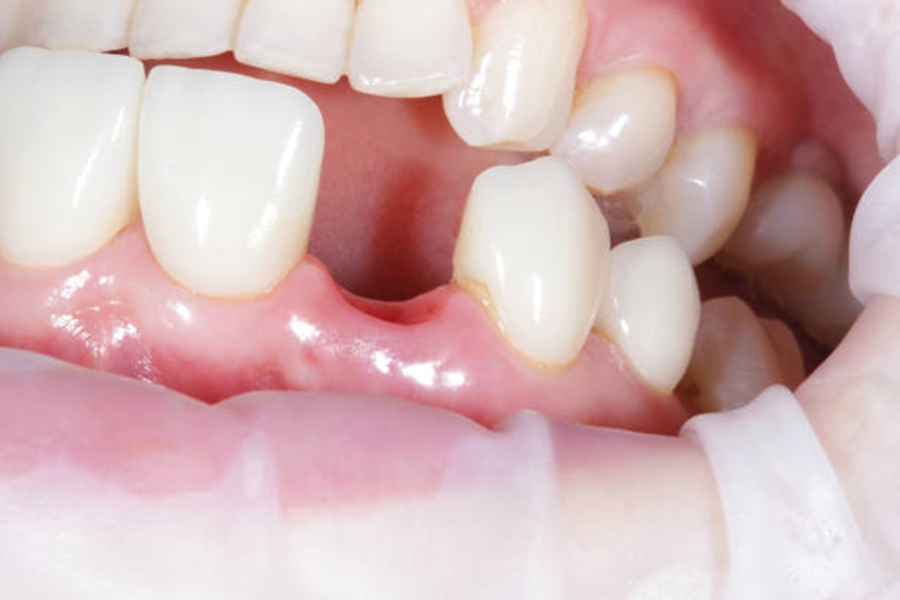 Cavity on front tooth