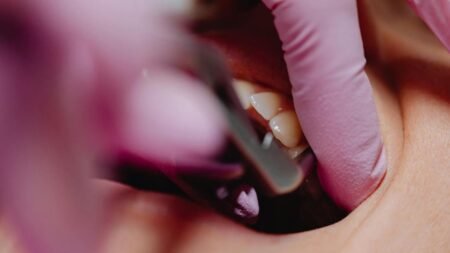 laser treatment for periodontal gum disease​